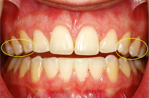 How to Manage White Spot Lesions Vivek Mehta How to Manage White Spot Lesions Featured Image