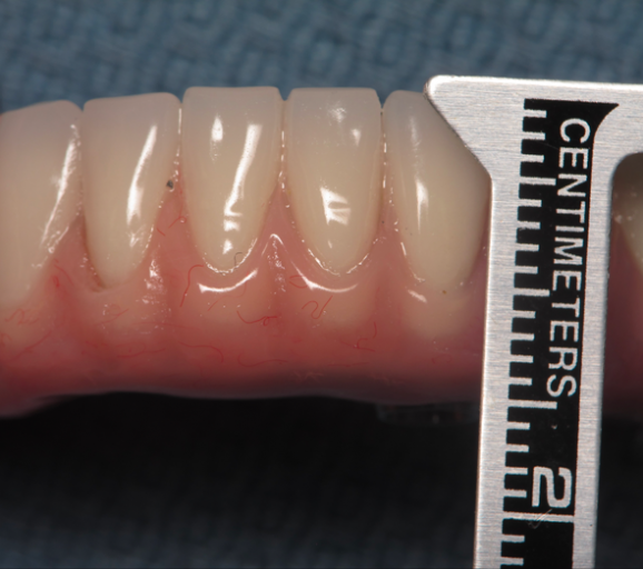 Success in Space With a Fixed Hybrid Prosthesis William Ralstin Success in Space With a Fixed Hybrid Prosthesis Figure 1