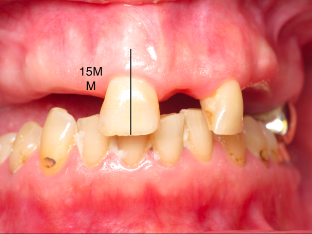 Success in Space With a Fixed Hybrid Prosthesis William Ralstin Success in Space With a Fixed Hybrid Prosthesis Figure 3