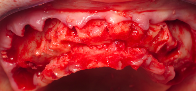 Success in Space With a Fixed Hybrid Prosthesis William Ralstin Success in Space With a Fixed Hybrid Prosthesis Figure 4