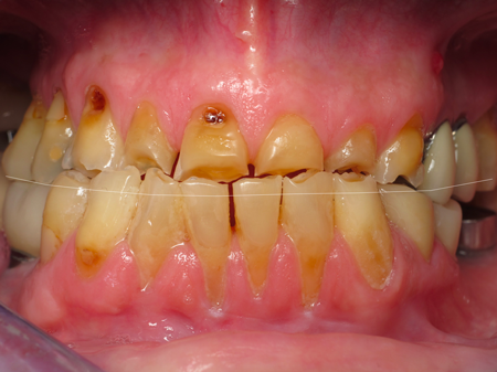 Success in Space With a Fixed Hybrid Prosthesis William Ralstin Success in Space With a Fixed Hybrid Prosthesis Figure 5