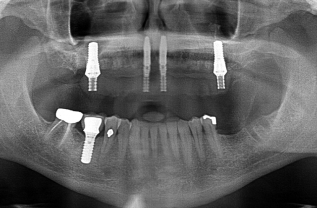 Success in Space With a Fixed Hybrid Prosthesis William Ralstin Success in Space With a Fixed Hybrid Prosthesis Figure 7