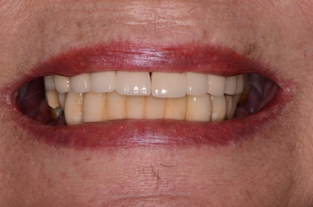 Best Practices for Presenting the Immediate Fixed Hybrid Case WilliamRalstin best practices for presenting the immediate fixed hybrid case Fig.1