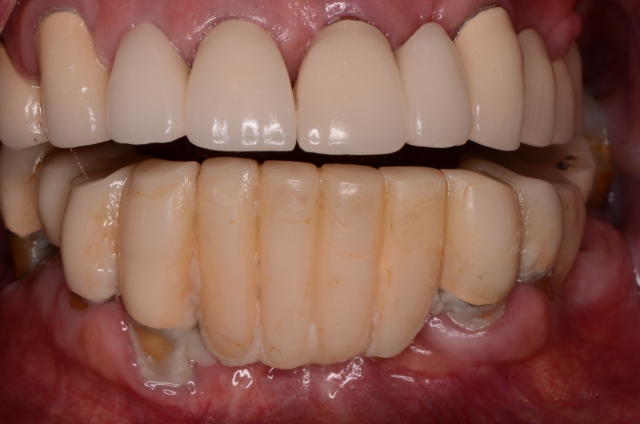 Best Practices for Presenting the Immediate Fixed Hybrid Case WilliamRalstin best practices for presenting the immediate fixed hybrid case Fig.2