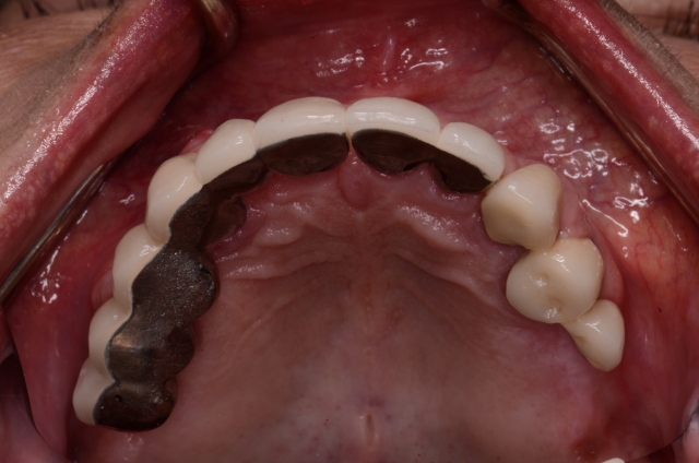 Best Practices for Presenting the Immediate Fixed Hybrid Case WilliamRalstin best practices for presenting the immediate fixed hybrid case Fig.3
