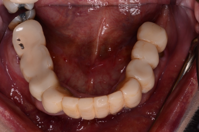 Best Practices for Presenting the Immediate Fixed Hybrid Case WilliamRalstin best practices for presenting the immediate fixed hybrid case Fig.4