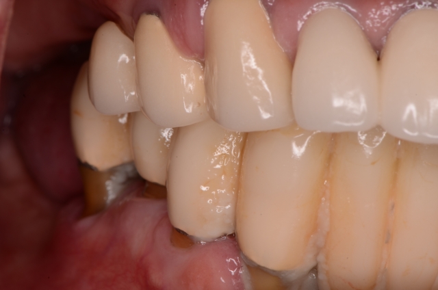 Best Practices for Presenting the Immediate Fixed Hybrid Case WilliamRalstin best practices for presenting the immediate fixed hybrid case Fig.5