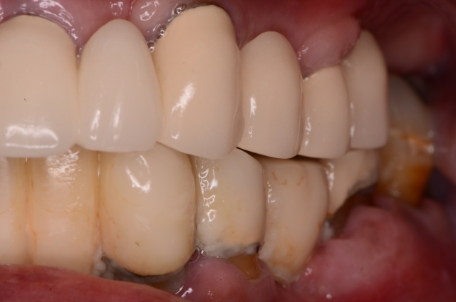 Best Practices for Presenting the Immediate Fixed Hybrid Case WilliamRalstin best practices for presenting the immediate fixed hybrid case Fig.6
