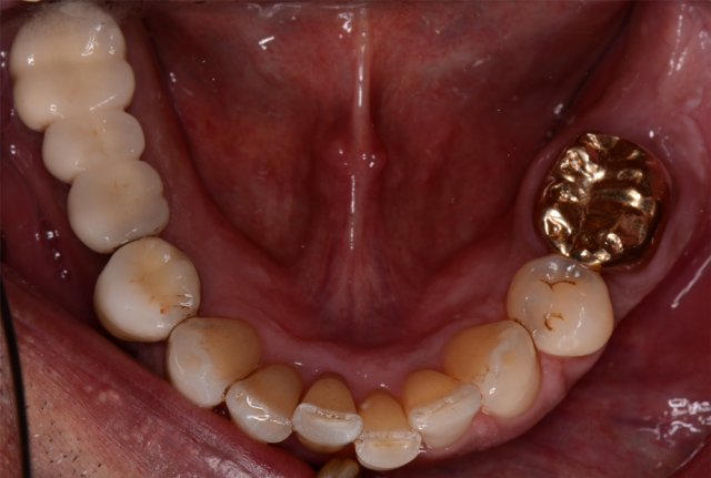 Records Necessary for Delivery of an Immediate Fixed Hybrid Case WilliamRalstin records necessary for delivery of an immediate fixed hybrid case Fig.2