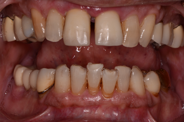 Records Necessary for Delivery of an Immediate Fixed Hybrid Case WilliamRalstin records necessary for delivery of an immediate fixed hybrid case Fig.3