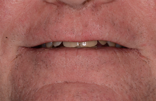 Records Necessary for Delivery of an Immediate Fixed Hybrid Case WilliamRalstin records necessary for delivery of an immediate fixed hybrid case Fig.5