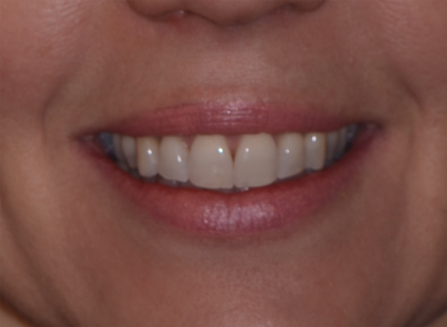 Records Necessary for Delivery of an Immediate Fixed Hybrid Case WilliamRalstin records necessary for delivery of an immediate fixed hybrid case Fig.6