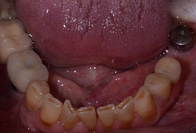 Terminal Dentition: 6 Common Causes WilliamRalstin terminal dentition 6 common causes FeaturedImage