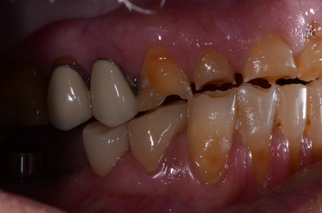 WilliamRalstin terminal dentition 6 common causes Fig.4