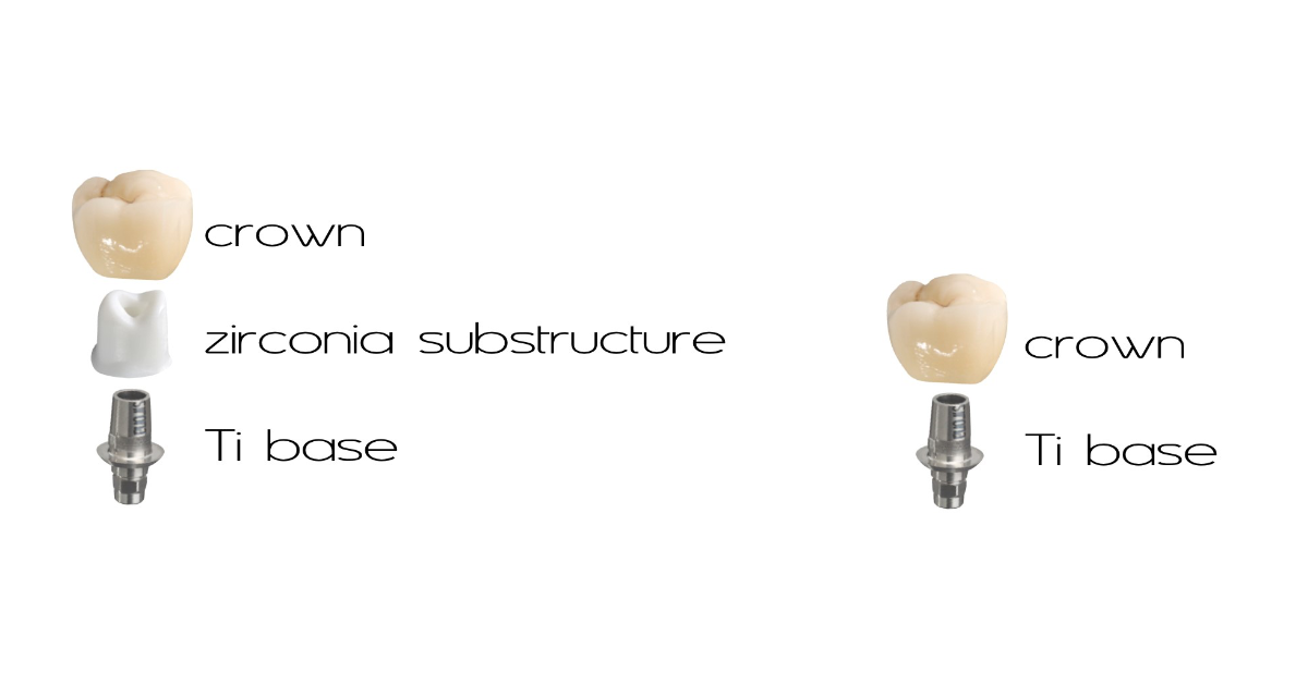 Bonding a Titanium Base to an Implant Abutment or Crown: Is There an Optimal Material and Technique? Winter bonding titanium base implant abutment 01