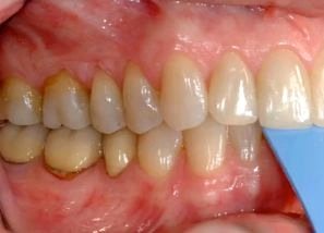 Three Options to Restore Patients in CR image 15