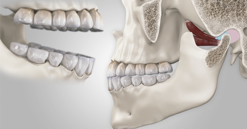 TMJ and Treatment Planning: Treating Joint Issues for More Predictable Results mckee tmj treatment planning treating joint 02