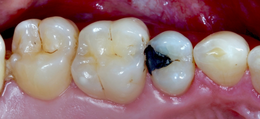 smithson closing class 2 restoration pt1 01