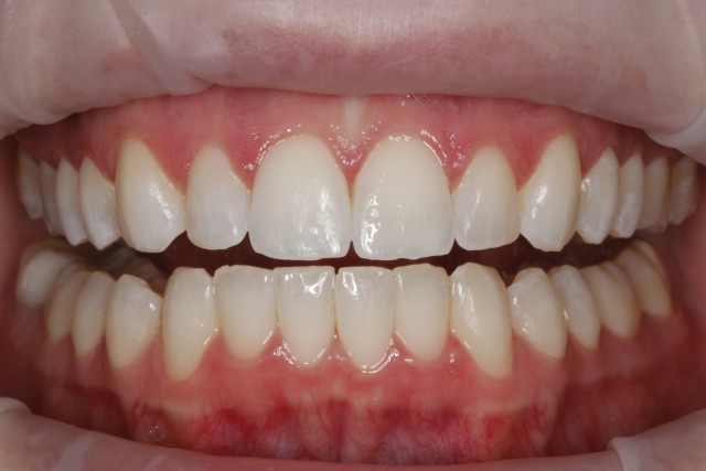 A Conservative, Effective Approach to White Spot Lesions CourtneyLavigne a conservative effective approach to white spot lesions FeaturedImage