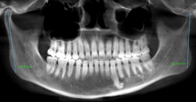 Temporomandibular Joint Space and Articular Disk Position: Is There a Correlation? Curt Ringhofer Temporomandibular Joint Space and Articular Disk Position Featured Image