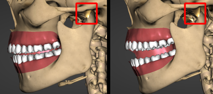 Temporomandibular Joint Space and Articular Disk Position: Is There a Correlation? Curt Ringhofer Temporomandibular Joint Space and Articular Disk Position Figure 1