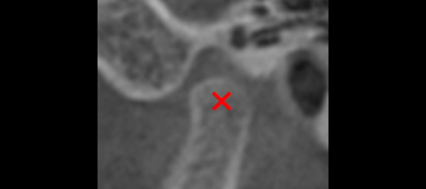 Temporomandibular Joint Space and Articular Disk Position: Is There a Correlation? Curt Ringhofer Temporomandibular Joint Space and Articular Disk Position Figure 2