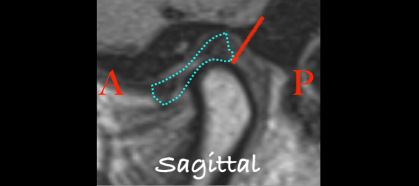 Temporomandibular Joint Space and Articular Disk Position: Is There a Correlation? Curt Ringhofer Temporomandibular Joint Space and Articular Disk Position Figure 3