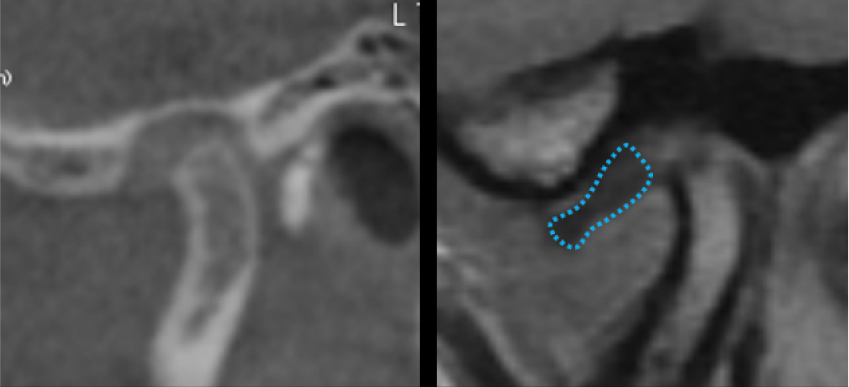 Temporomandibular Joint Space and Articular Disk Position: Is There a Correlation? Curt Ringhofer Temporomandibular Joint Space and Articular Disk Position Figure 4