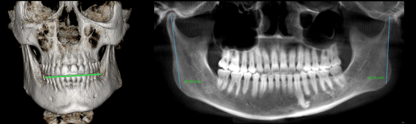 Temporomandibular Joint Space and Articular Disk Position: Is There a Correlation? Curt Ringhofer Temporomandibular Joint Space and Articular Disk Position Figure 5