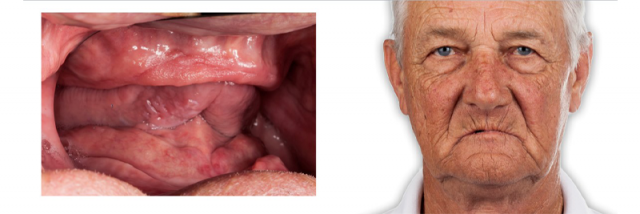 Options for Determining Vertical Dimension With Edentulous Patients DarinDichter options for determining vertical dimension with edentulous patients FeaturedImage