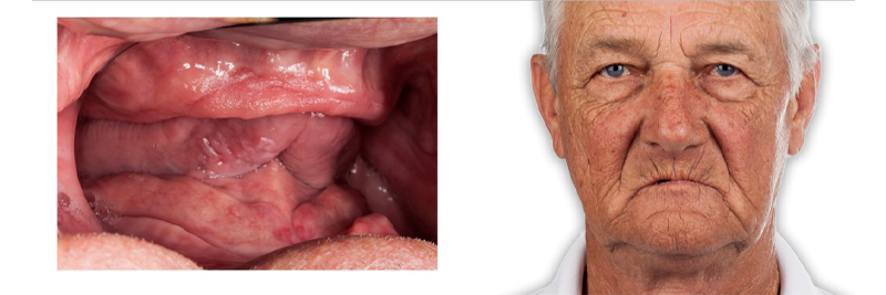 Options for Determining Vertical Dimension With Edentulous Patients DarinDichter options for determining vertical dimension with edentulous patients Fig.1