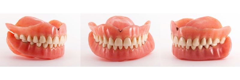 Options for Determining Vertical Dimension With Edentulous Patients DarinDichter options for determining vertical dimension with edentulous patients Fig.2