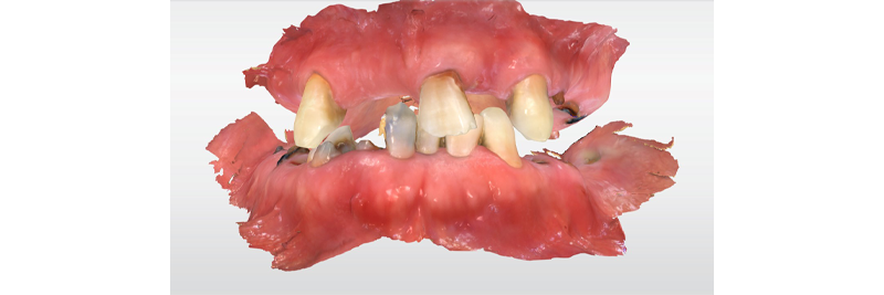 Options for Determining Vertical Dimension With Edentulous Patients DarinDichter options for determining vertical dimension with edentulous patients Fig.3