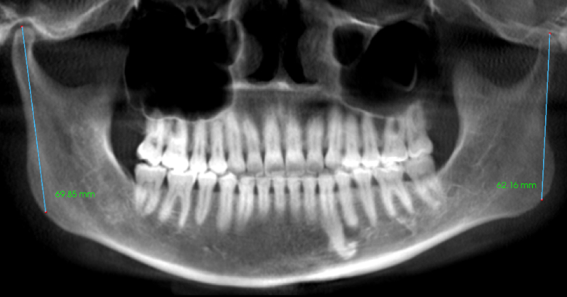 Temporomandibular Joint Space and Articular Disk Position: Is There a Correlation? Featured image for Curt Ringhofer's article
