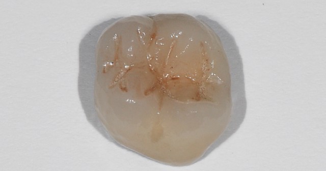JeffreyBonk spear resident faculty qa zirconia crowns FeaturedImage