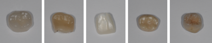 Spear Resident Faculty Q&A: Zirconia Crowns JeffreyBonk spear resident faculty qa zirconia crowns Fig.1
