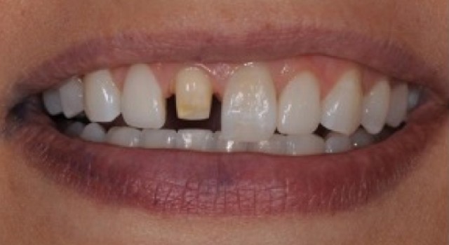 The Single Central Checklist in Anterior Tooth Restoration