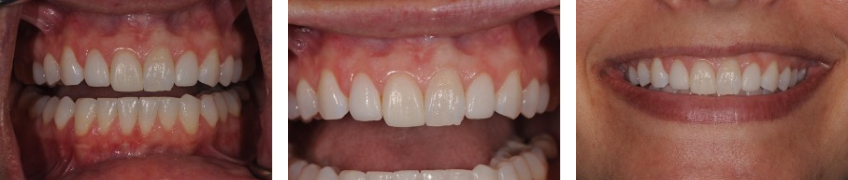 The Single Central Checklist in Anterior Tooth Restoration JeffreyBonk the single central checklist in anterior tooth restoration Fig.1