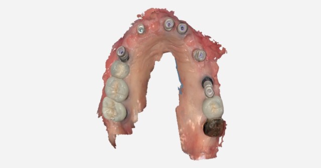 JohnCarson taking records for day to day implant restorations featuredImage