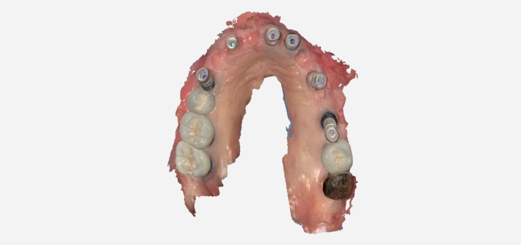 JohnCarson taking records for day to day implant restorations fig.1