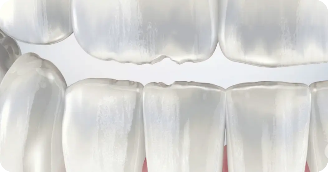 Understanding Tooth Wear