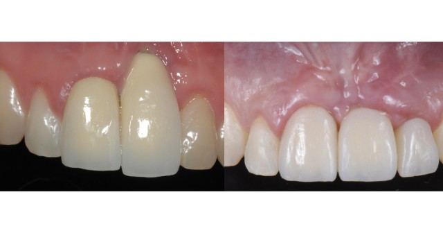 Ricardo Mitrani Managing Implant Challenges in the Esthetic Zone Featured IMage