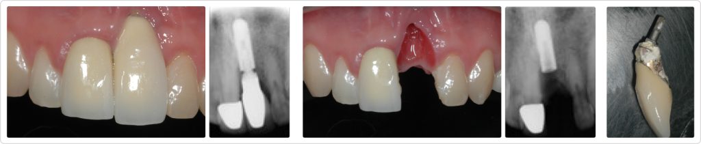 Ricardo Mitrani Managing Implant Challenges in the Esthetic Zone Figure 1 5