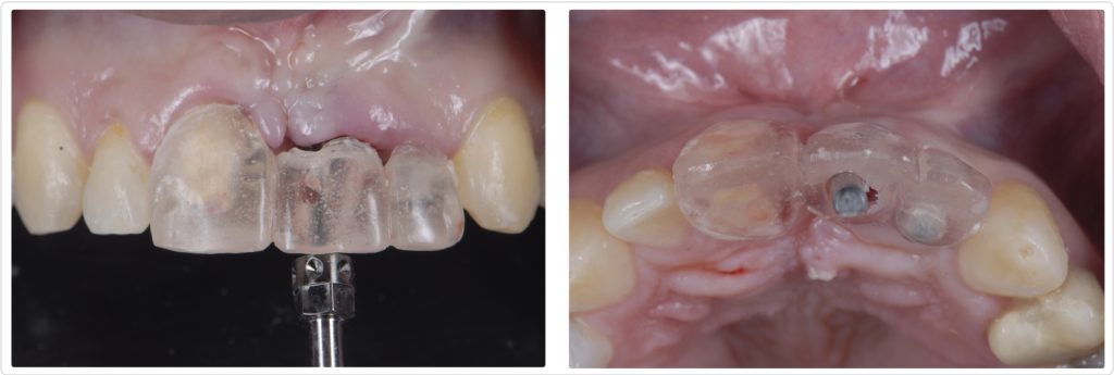 Ricardo Mitrani Managing Implant Challenges in the Esthetic Zone Figure 11 12