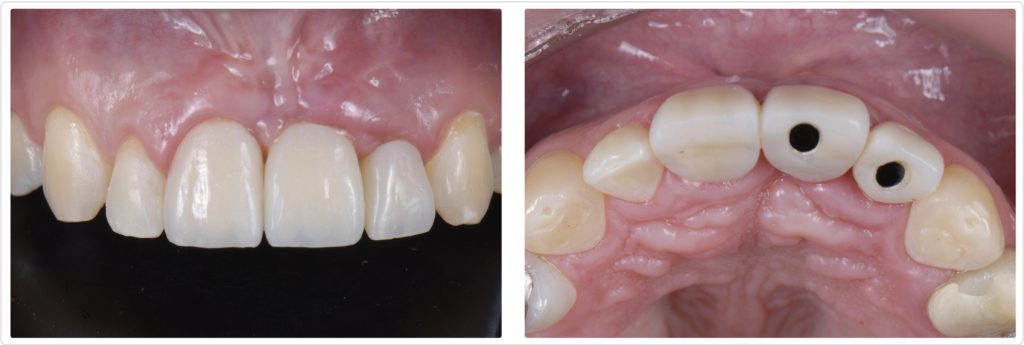 Ricardo Mitrani Managing Implant Challenges in the Esthetic Zone Figure 13 14