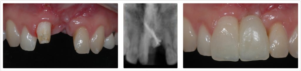 Ricardo Mitrani Managing Implant Challenges in the Esthetic Zone Figure 6 8
