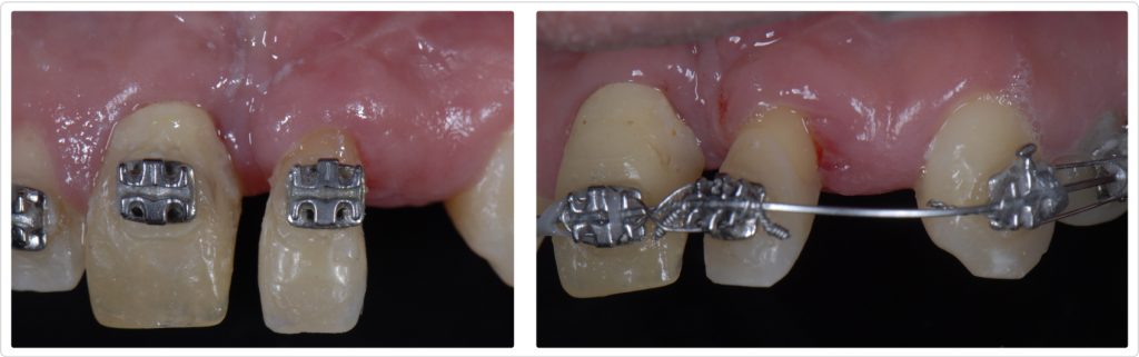 Ricardo Mitrani Managing Implant Challenges in the Esthetic Zone Figure 9 10