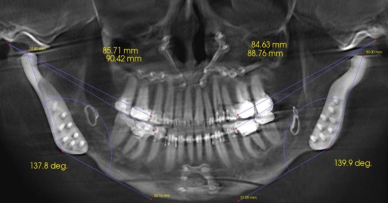 Occlusal Stability article by Dr. Curt Ringhofer