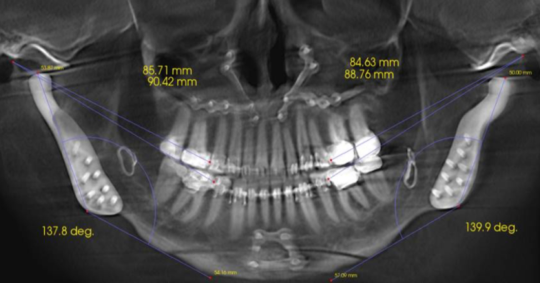 Occlusal Stability: When Is It Safe To Treat? Occlusal Stability article by Dr. Curt Ringhofer