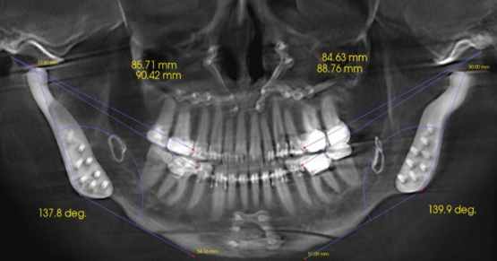 Spear Digest Occlusal Stability article by Dr. Curt Ringhofer